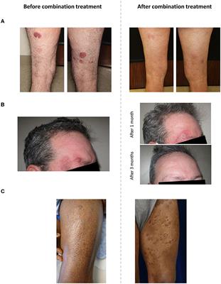 Chlormethine gel in combination with other therapies for treatment of mycosis fungoides: a review with patient cases